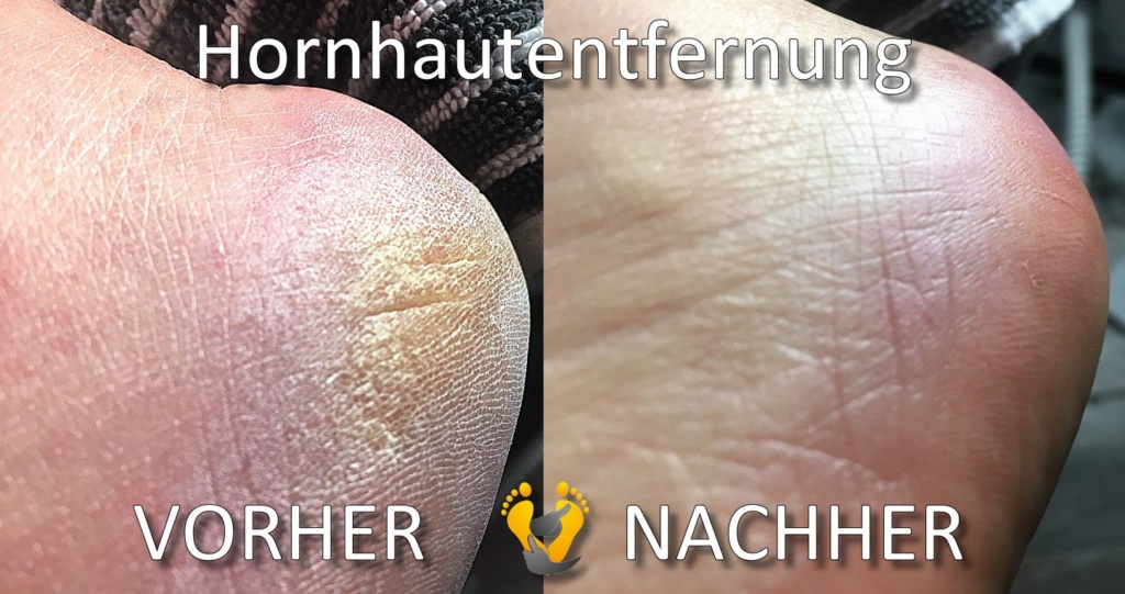 Hornhaut Löst Sich Ab Fuß susannebuechmann.de